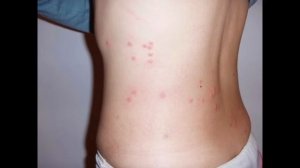 Как выглядят укусы постельных клопов: фото, видео.