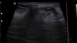 Грыжа передней брюшной стенки (30-6-17)