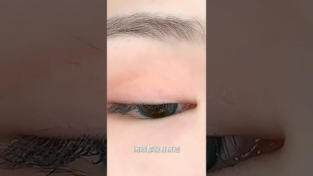 Enjoy every day with Spa Acne Treatment #VisionShow Acne scar
