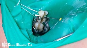 Преэндодонтический билдап 15, фиксация флоса файлом, а матрицы клампом B3 DET.expert & Sanctuary 4K