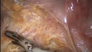 КОЛПРОКТЭКТОМИЯ ДИФФУЗНЫЙ ПОЛИПОЗ