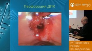 Эндоскопическое ушивание перфорации двенадцатиперстной кишки