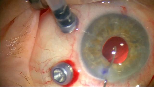 Фланцевая фиксация вывихнутой ИОЛ смотреть онлайн