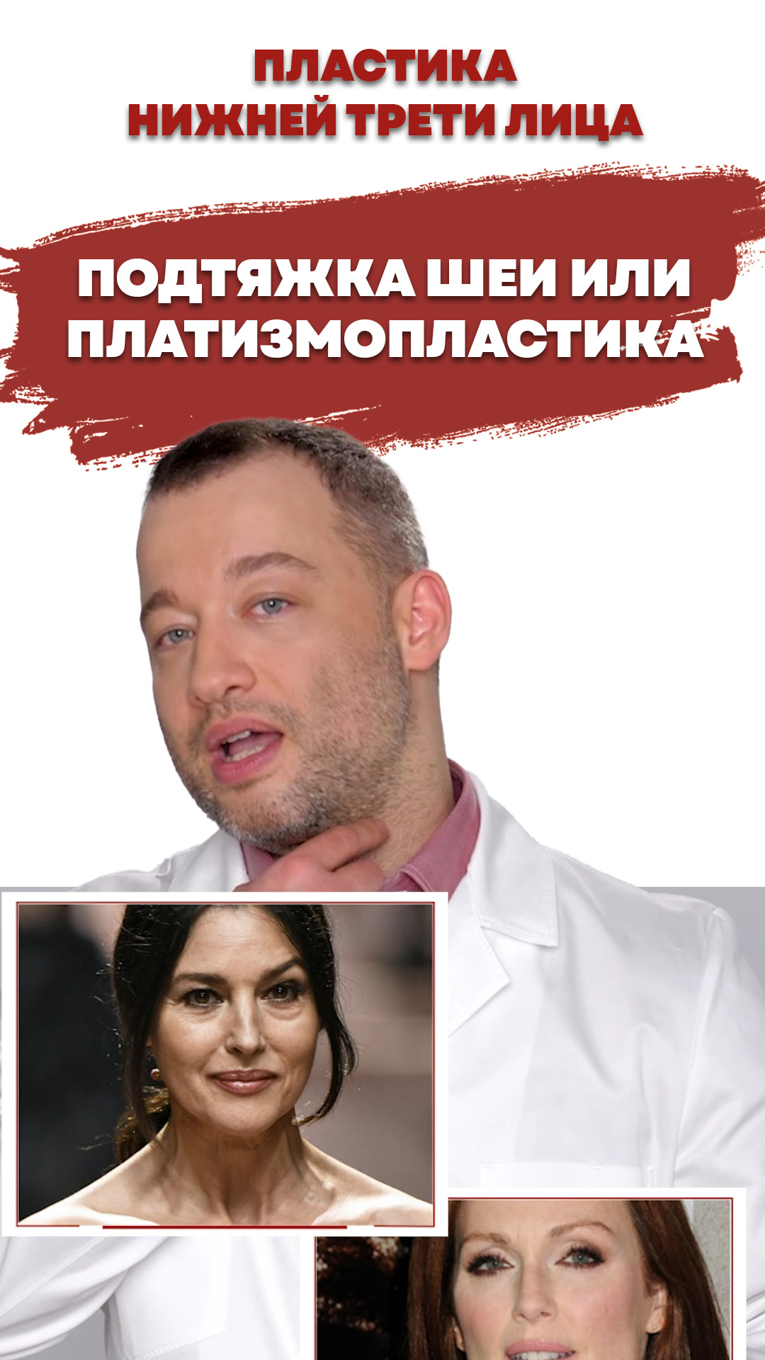 Подтяжка шеи или платизмопластика