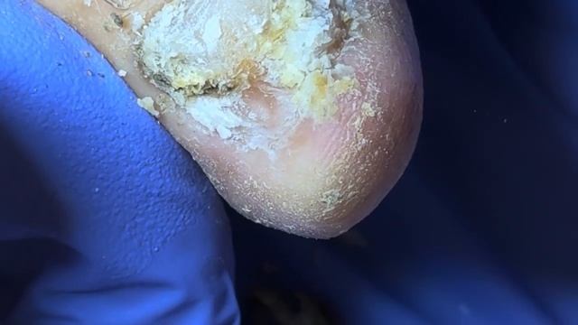 Super thick onychomycosis, minus the black mud there is still 5cm【Doctor Liu Pedicure】 смотреть онлайн