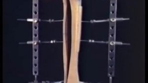 dispositivo universale professor Ilizarov - Итальянский- универсальный аппарат профессора Илизарова