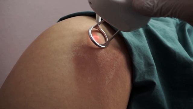 Лазерное Удаление Растяжек