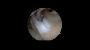 Arthroscopic Tenoplasty in Congenital Split Biceps Long Head