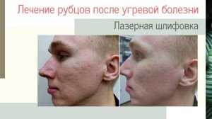 Лечение рубцов постакне. До и результат спустя 6 дней! Всего одна процедура!