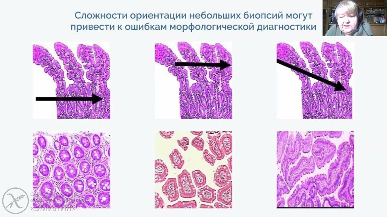 Обязательна ли биопсия для диагностики целиакии?