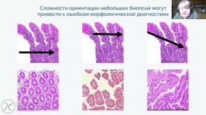 Обязательна ли биопсия для диагностики целиакии?