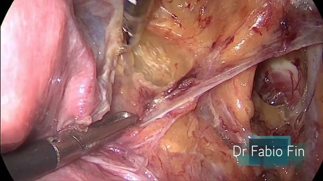 Laparoscopic Sentinel lymph node cervical cancer