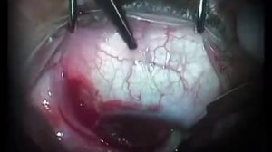 Хирургия птеригиума