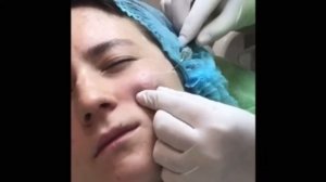 Работа препаратами гиалуроновой кислоты Увеличение скул. Врач Алла Ветрова