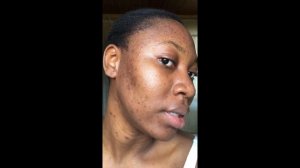 The ordinary peeling solution 4 weeks review with (before & after) tik tok made me do it