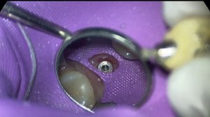 How to Remove a Cement Retained Implant Crown (Crown is Loose)