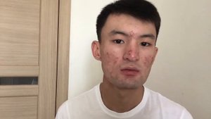 АКНЕКУТАН. РОАККУТАН. 22 день приема