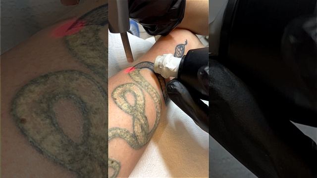 Удаляем змею на руке ?? #tattooremoval #удалениетату | студия в Питере "Битый Небитого"