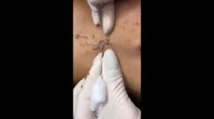 Удаляем гнойный чирей !!!