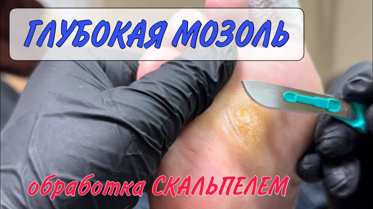 🥕МОЗОЛЬ на ноге _ как убрать мозоль _ курсы подологии