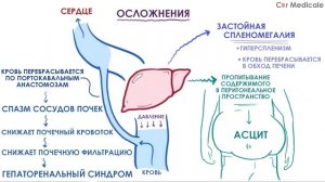 Цирроз печени - причины, патогенез, симптомы, осложнения