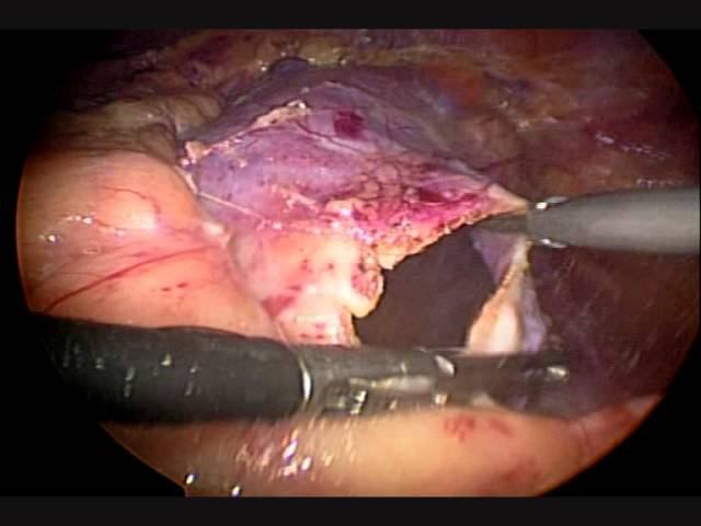 резекция кисты почки (deroofing) Аболмасов А.В. смотреть онлайн