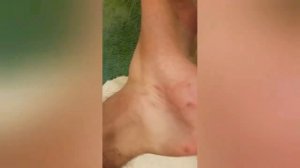 Удаление мазоли на ноге