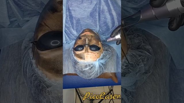 Карбоновый пилинг(с объяснением) смотреть онлайн