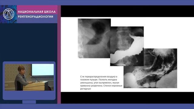 Г.А. Сташук - Рак желудка (клинические наблюдения) смотреть онлайн