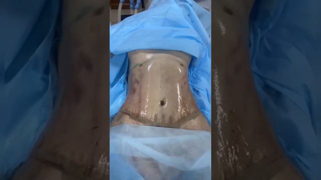Липоабдоминопластика. Работа пластического хирурга - Салихова Муслима Абдурашидовича