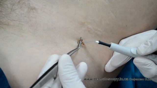 Папиллома, удаление методом высокочастотной электрохирургии смотреть онлайн