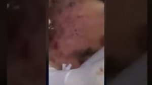 How To Removal LARGE Blackheads  - Best Pimple Popping Videos part 2