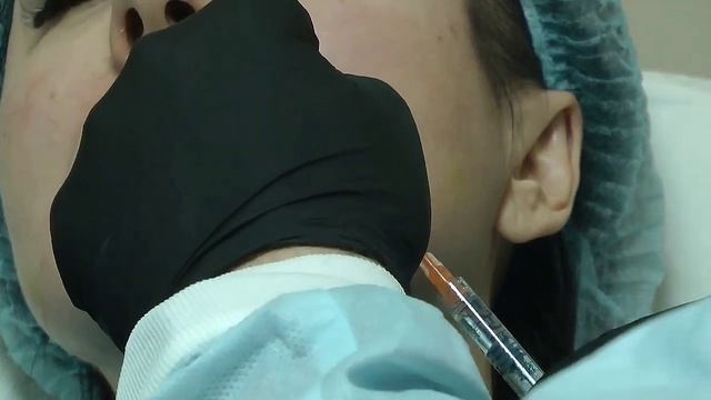 Коррекция носогубных складок филлерами с помощью атравматической канюли.