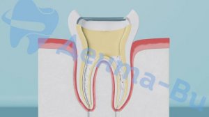 Лечение пульпита