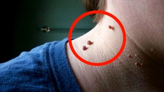 Фибромы как избавиться от них смотреть онлайн