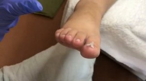 Как МЫ тампонируем ногтевые пазухи  с нагельмассой + каполин и отпускаем клиента на 4 недели?