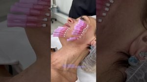 Нитевая подтяжка лица в клинике Новая Косметология в Москве