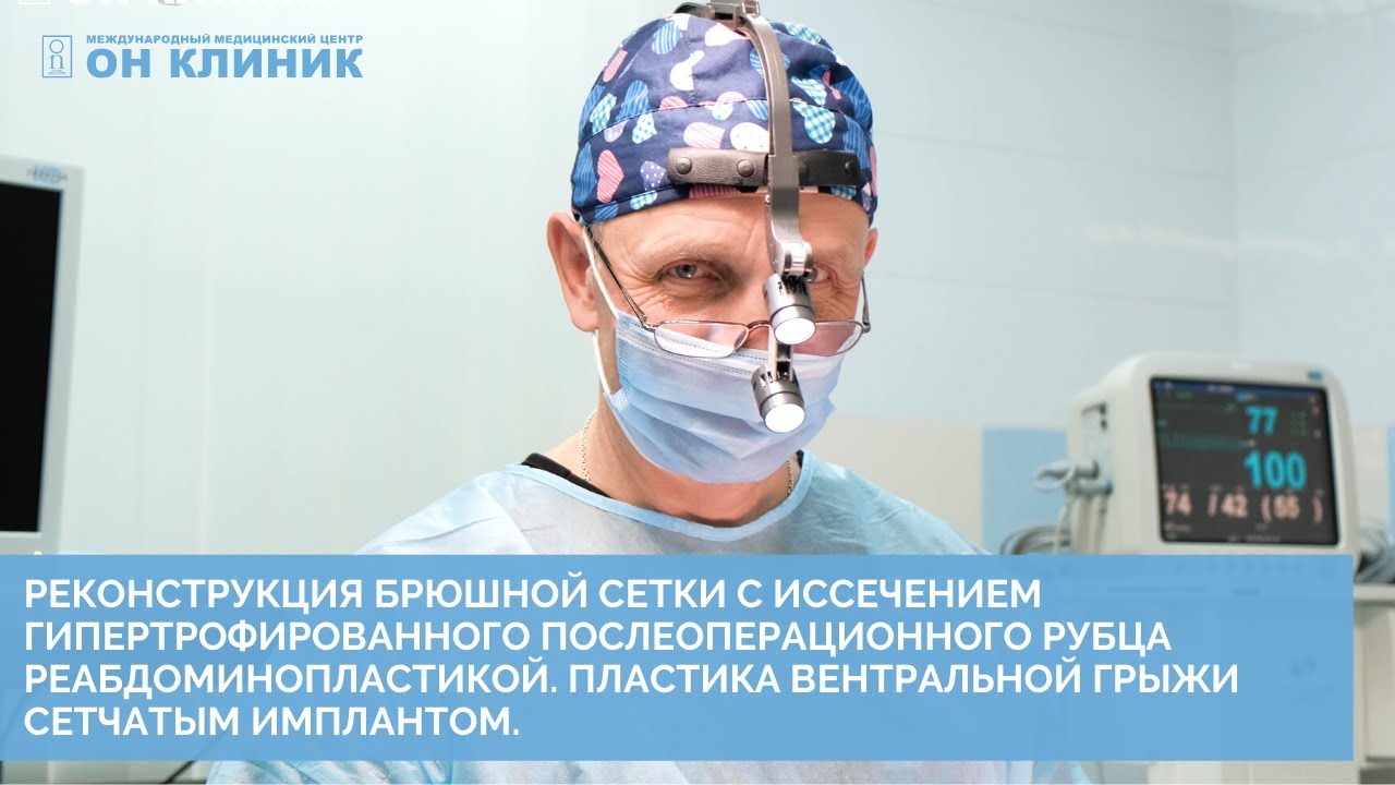 Иссечение рубца с реабдоминопластикой. Пластика грыжи сетчатым имплантом в ОН КЛИНИК.