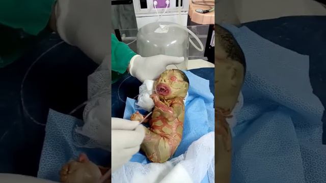 Harlequin ichthyosis - A baby born with icthyosis harlequin