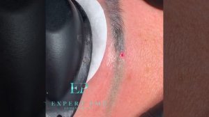 Удаление перманентного макияжа и татуажа лазером