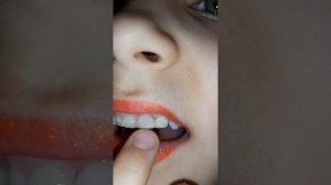 Шатается молочный зуб. Что делать?