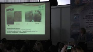 Мозоли. Виды мозолей.Стержневые мозоли. Техника удаления стержневых мозолей.