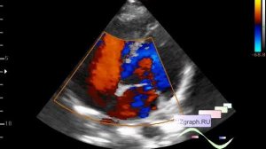 Детское УЗИ сердца (эхокардиография) - Двухструйная регургитация на митральном клапане