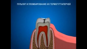 Пульпит или осложнение кариеса