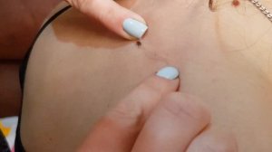 Как удалить клеща