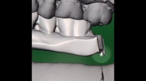 VSP for fibula free flap with immediate dental implants (Jaw in a day)