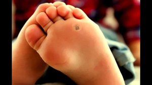 Рецепт от мозолей и подошвенных бородавок из воска и прополиса