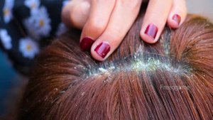 Huge Dandruff Flakes Removing And Picking ASMR # 968
