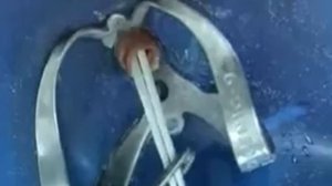 Фиксация стекловолоконных штифтов