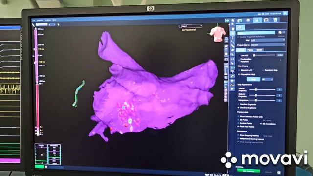 РЧА (радиочастотная аблация) предсердной тахикардии/трепетания предсердий смотреть онлайн